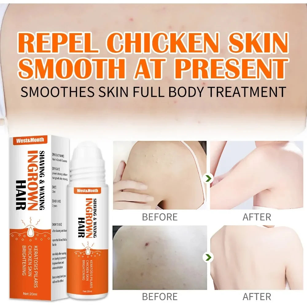 Ingrown Hair Treatment