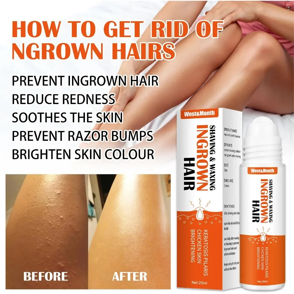Ingrown Hair Treatment