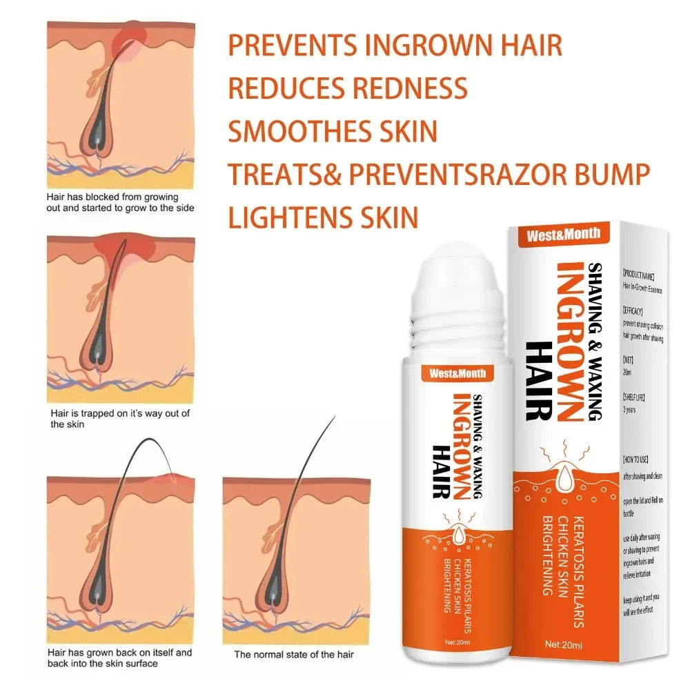 Ingrown Hair Treatment